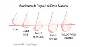 Clasificación de Regnault de Ptosis Mamaria que se establece por la localización del pezón respecto al surco submamario