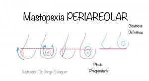 Mastopexia periareolar
