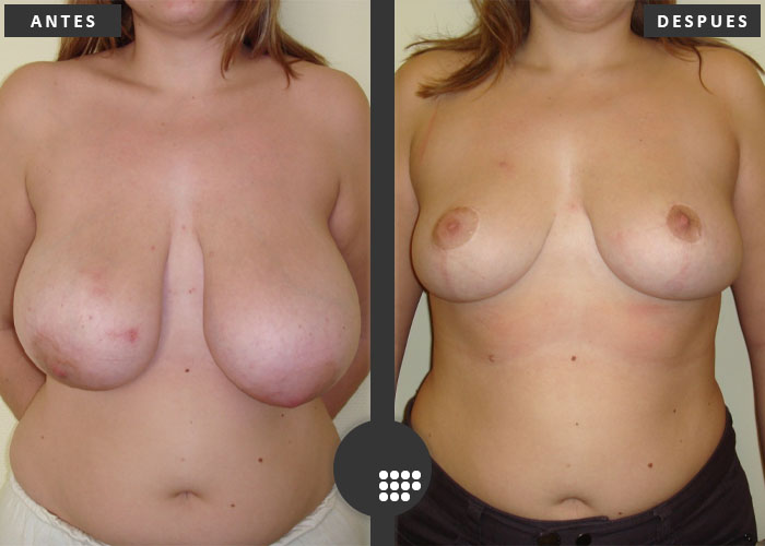 Reducción mamaria en paciente con hipertrofia mamaria