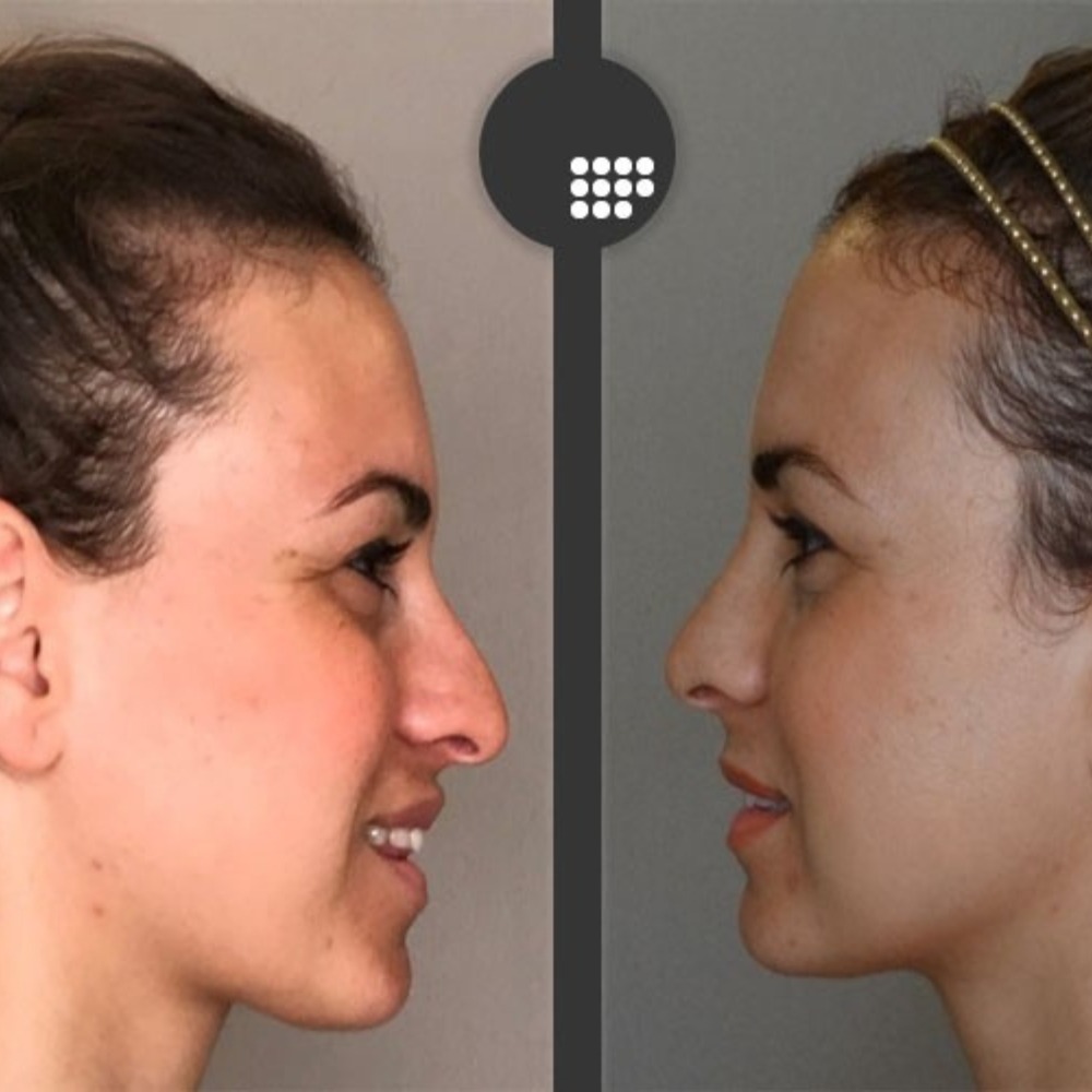 Foto del antes y despues de una rinoplastia