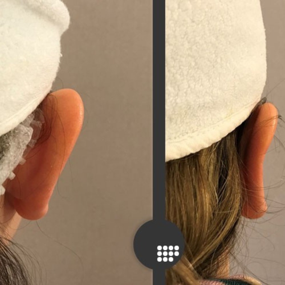 Imagen del antes y despues de una Otoplastia en un paciente