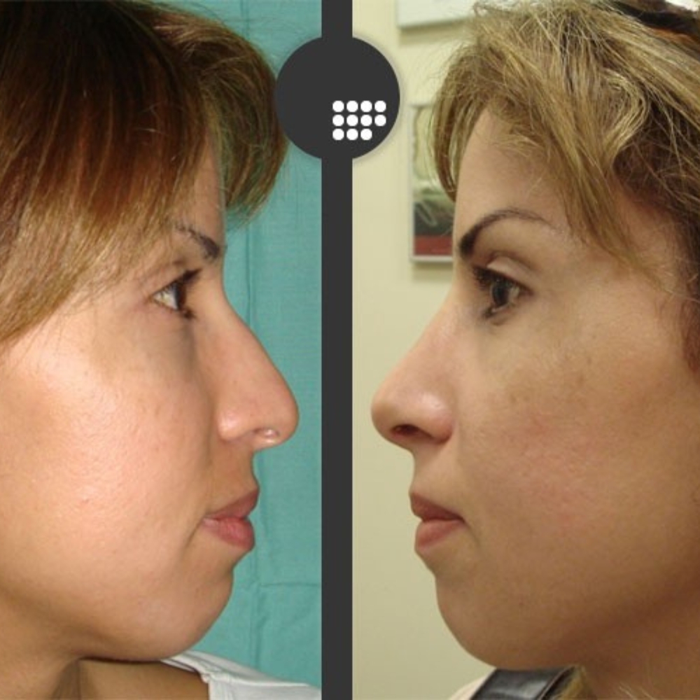 foto del antes y despues de una Rinoplastia en un paciente